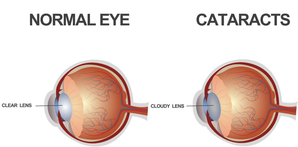 Cataract